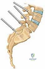 صورة توضيحية لـ علاج الانزلاق الفقاري عالي الدرجة: تخفيف الضغط والدمج الخلفي الجانبي ودمج الفقرات بين الأجسام الفقرية مع الأستاذ الدكتور محمد هطيف في صنعاء
