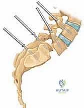 صورة توضيحية لـ علاج الانزلاق الفقاري عالي الدرجة: تخفيف الضغط والدمج الخلفي الجانبي ودمج الفقرات بين الأجسام الفقرية مع الأستاذ الدكتور محمد هطيف في صنعاء