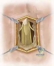 صورة توضيحية لـ علاج الانزلاق الفقاري عالي الدرجة: تخفيف الضغط والدمج الخلفي الجانبي ودمج الفقرات بين الأجسام الفقرية مع الأستاذ الدكتور محمد هطيف في صنعاء