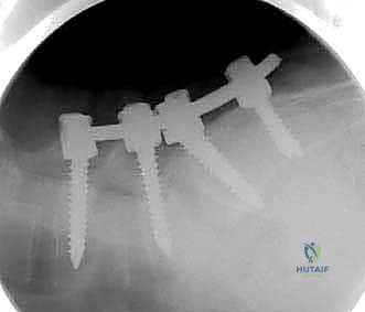 صورة توضيحية لـ علاج الانزلاق الفقاري عالي الدرجة: تخفيف الضغط والدمج الخلفي الجانبي ودمج الفقرات بين الأجسام الفقرية مع الأستاذ الدكتور محمد هطيف في صنعاء