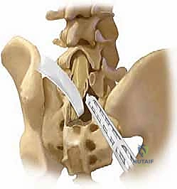 تقييم طبي لحالة انزلاق فقاري ناتج عن عيب خلقي