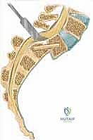 فحص سريري يوضح تأثير الانزلاق على الأعصاب الطرفية