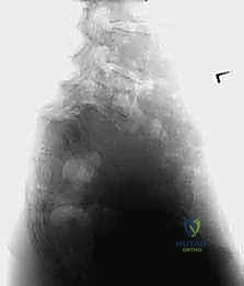 خطوة تخفيف الضغط العصبي وإزالة الصفيحة الفقرية