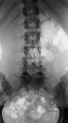 صورة رنين مغناطيسي توضح تضيق القناة الشوكية الشديد