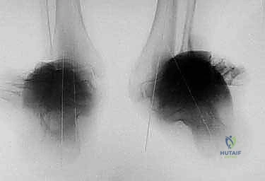 تشريح مفصل الكاحل وتشوهات الساق