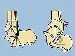 صورة طبية: قطع العظم فوق الكاحل بالتثبيت الخارجي تصحيح تشوهات الساق البعيدة مع الأستاذ الدكتور محمد هطيف