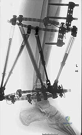 حالة تشوه خلقي في الساق