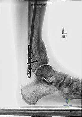 دقة إدخال الأسلاك الجراحية