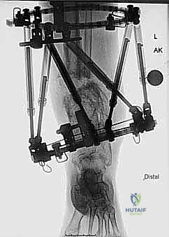 أشعة تظهر سوء التحام عظم الساق
