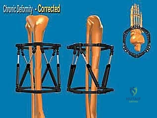 موقع قطع العظم المثالي فوق الكاحل