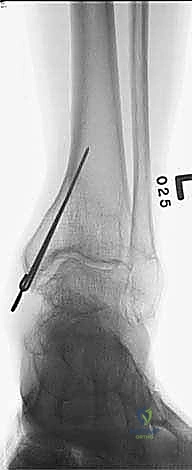 مقارنة بين التثبيت الداخلي والخارجي