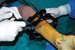 صورة توضيحية لـ قطع العظم فوق الكاحل بالتثبيت الخارجي تصحيح تشوهات الساق البعيدة مع الأستاذ الدكتور محمد هطيف