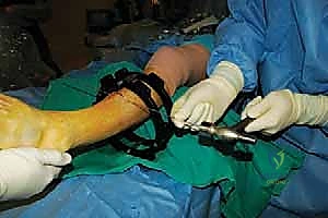 صورة توضيحية لـ قطع العظم فوق الكاحل بالتثبيت الخارجي تصحيح تشوهات الساق البعيدة مع الأستاذ الدكتور محمد هطيف