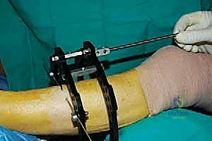 صورة توضيحية لـ قطع العظم فوق الكاحل بالتثبيت الخارجي تصحيح تشوهات الساق البعيدة مع الأستاذ الدكتور محمد هطيف