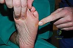 صورة توضيحية لـ قطع العظم فوق الكاحل بالتثبيت الخارجي تصحيح تشوهات الساق البعيدة مع الأستاذ الدكتور محمد هطيف