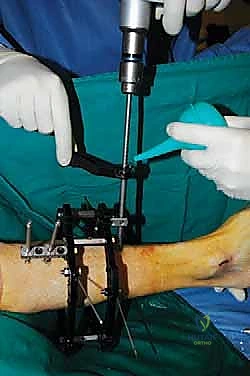 صورة توضيحية لـ قطع العظم فوق الكاحل بالتثبيت الخارجي تصحيح تشوهات الساق البعيدة مع الأستاذ الدكتور محمد هطيف