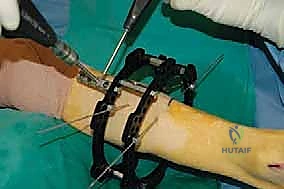 صورة طبية: قطع العظم فوق الكاحل بالتثبيت الخارجي تصحيح تشوهات الساق البعيدة مع الأستاذ الدكتور محمد هطيف