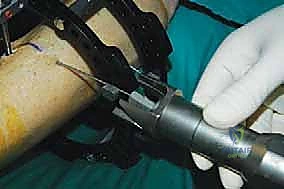 صورة طبية: قطع العظم فوق الكاحل بالتثبيت الخارجي تصحيح تشوهات الساق البعيدة مع الأستاذ الدكتور محمد هطيف