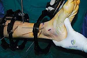 صورة طبية: قطع العظم فوق الكاحل بالتثبيت الخارجي تصحيح تشوهات الساق البعيدة مع الأستاذ الدكتور محمد هطيف