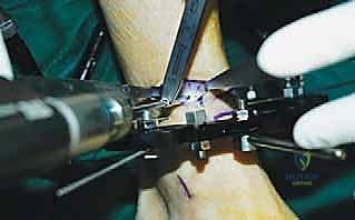 صورة طبية: قطع العظم فوق الكاحل بالتثبيت الخارجي تصحيح تشوهات الساق البعيدة مع الأستاذ الدكتور محمد هطيف