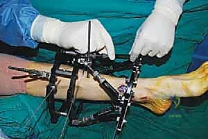 صورة طبية: قطع العظم فوق الكاحل بالتثبيت الخارجي تصحيح تشوهات الساق البعيدة مع الأستاذ الدكتور محمد هطيف