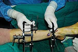 صورة طبية: قطع العظم فوق الكاحل بالتثبيت الخارجي تصحيح تشوهات الساق البعيدة مع الأستاذ الدكتور محمد هطيف