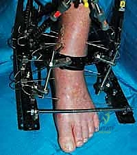 صورة طبية: قطع العظم فوق الكاحل بالتثبيت الخارجي تصحيح تشوهات الساق البعيدة مع الأستاذ الدكتور محمد هطيف