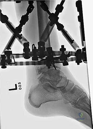 صورة طبية: قطع العظم فوق الكاحل بالتثبيت الخارجي تصحيح تشوهات الساق البعيدة مع الأستاذ الدكتور محمد هطيف