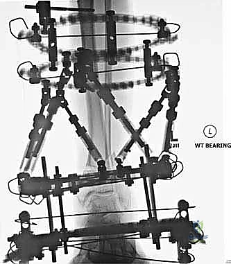 صورة طبية: قطع العظم فوق الكاحل بالتثبيت الخارجي تصحيح تشوهات الساق البعيدة مع الأستاذ الدكتور محمد هطيف
