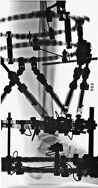 صورة طبية: قطع العظم فوق الكاحل بالتثبيت الخارجي تصحيح تشوهات الساق البعيدة مع الأستاذ الدكتور محمد هطيف