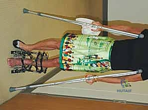 صورة طبية: قطع العظم فوق الكاحل بالتثبيت الخارجي تصحيح تشوهات الساق البعيدة مع الأستاذ الدكتور محمد هطيف