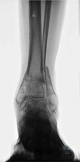 صورة طبية: قطع العظم فوق الكاحل بالتثبيت الخارجي تصحيح تشوهات الساق البعيدة مع الأستاذ الدكتور محمد هطيف