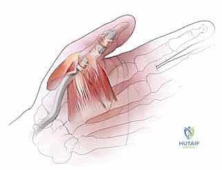 علاقة الأمراض المزمنة بظهور الإصبع الزنادي