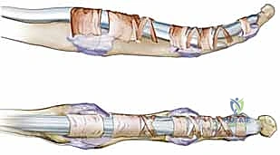 تأثير الإجهاد المتكرر على أوتار اليد