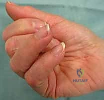 آلية انحشار الوتر داخل البكرة A1