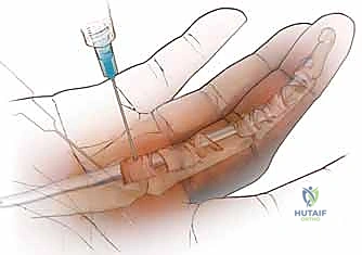 مراحل تطور الإصبع الزنادي وتيبس المفاصل