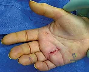 استخدام الجبائر الليلية كعلاج تحفظي