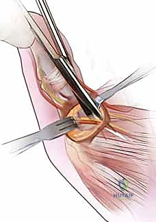 الأستاذ الدكتور محمد هطيف أثناء إجراء الجراحة