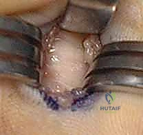 الشق الجراحي الدقيق في راحة اليد