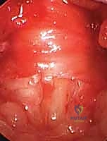 تحرير البكرة A1 بدقة متناهية