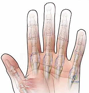 حقن الكورتيزون الموضعية لعلاج الالتهاب