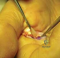 إغلاق الجرح بغرز تجميلية