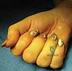 صورة توضيحية لـ الإصبع الزنادي: دليل شامل للتشخيص والعلاج المتقدم مع الأستاذ الدكتور محمد هطيف في صنعاء