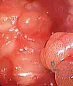 تمارين إعادة التأهيل بعد جراحة اليد