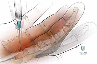 الأعراض السريرية وتصلب الأصابع