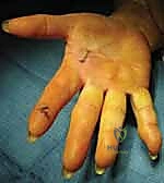 صورة توضيحية لـ الإصبع الزنادي: دليل شامل للتشخيص والعلاج المتقدم مع الأستاذ الدكتور محمد هطيف في صنعاء