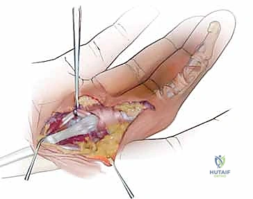 التشريح الدقيق للأوتار القابضة في اليد