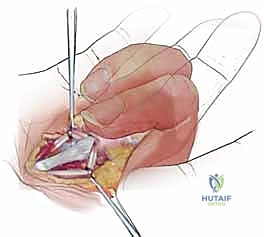 تأثير الإصبع الزنادي على حركة اليد اليومية