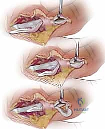 الإصبع الزنادي: دليل شامل للتشخيص والعلاج المتقدم مع الأستاذ الدكتور محمد هطيف في صنعاء