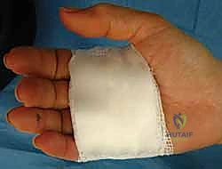 Illustration of ulnar slip excision - Dr. Mohammed Hutaif